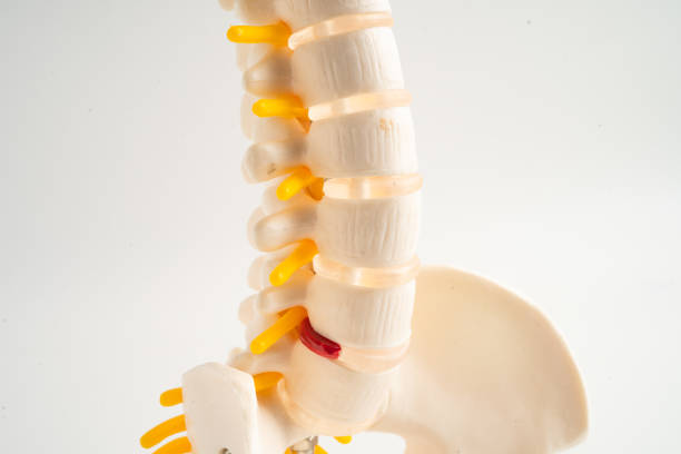 lumbar spine displaced herniated disc fragment, spinal nerve and bone. model for treatment medical in the orthopedic department. - slipped disc fotografías e imágenes de stock