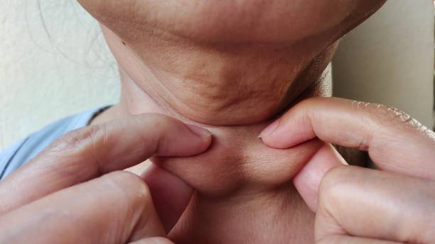 istock The  neck wattle and Flabby skin. 2075454556