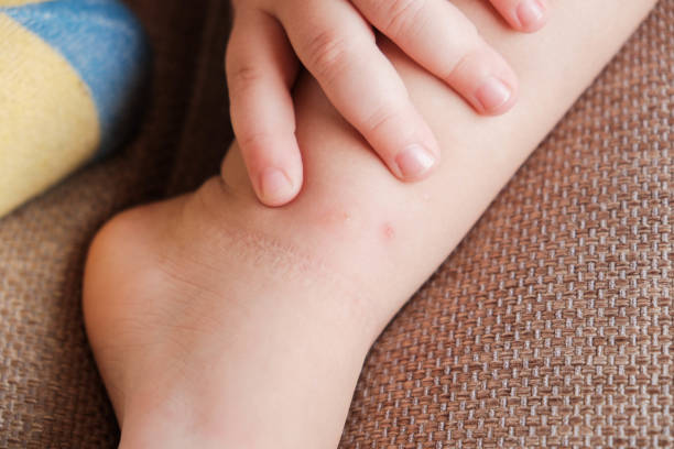 istock Toddler touches her leg after being bitten by mosquito or bedbug, suffering from allergic reaction and swelling, experiencing pain, sits on bed at home. Skin reaction to blood-sucking insects. Allergy 2076275934