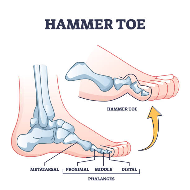 Hammer toe medical problem as foot phalanges deformation outline diagram Hammer toe medical problem anatomy with foot phalanges deformation outline diagram. Labeled educational scheme with bent metatarsal, proximal, middle and distal bones deformity vector illustration. human finger stock illustrations
