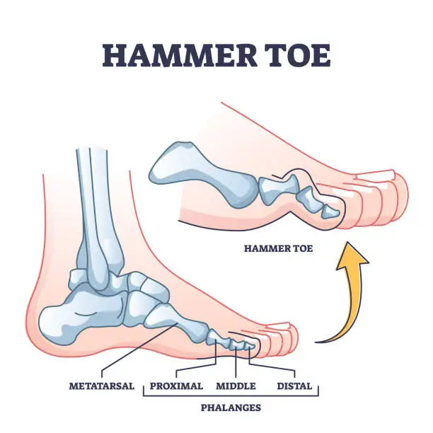 Vector illustration of Hammer toe medical problem as foot phalanges deformation outline diagram