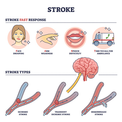 Stroke medical condition with fast response and types outline diagram. Labeled educational scheme with brain blood supply problem and ischemic, transient or hemorrhagic examples vector illustration.