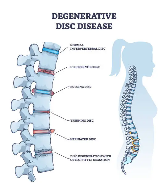 Vector illustration of Degenerative disc disease with spine and vertebra trauma outline diagram