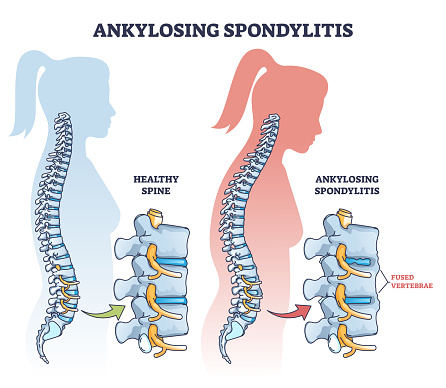 Ankylosing spondylitis as inflammatory spine bone disease outline diagram. Labeled educational anatomical comparison with healthy and damaged vertebrae vector illustration. Fused skeletal back parts.