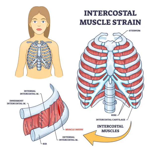 Vector illustration of Intercostal muscle strain as muscular group in chest cavity outline diagram