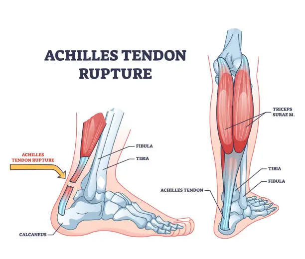 Vector illustration of Achilles tendon rupture as painful injury and leg trauma outline diagram