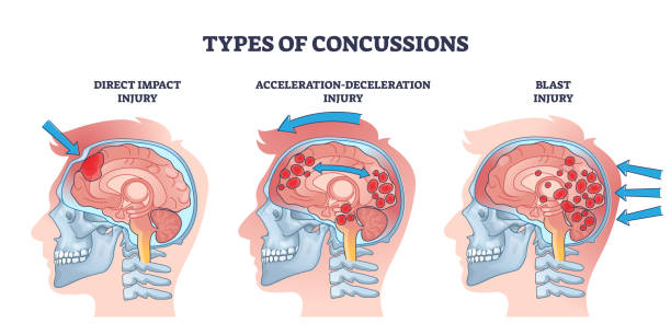 stockillustraties, clipart, cartoons en iconen met concussion and head trauma or injury types from medical view outline diagram - lichamelijk letsel