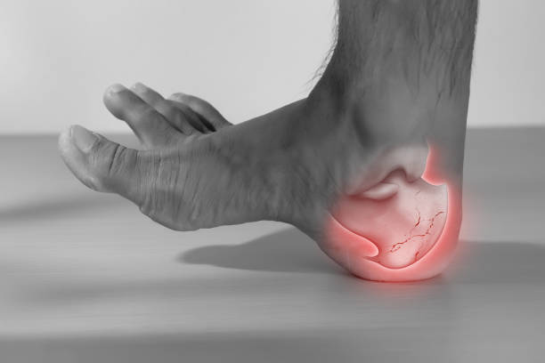 A man has a heel bone is broken. A man has a heel injury because his heel bone is broken. x ray tarsal ankle and foot stock pictures, royalty-free photos & images