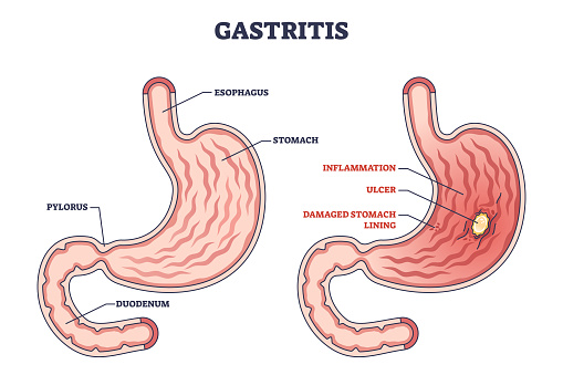 Gastritis as stomach lining inflammation illness and disease outline diagram. Labeled educational gastric problem with burning and pain in intestinal tract vector illustration. Medical structure.