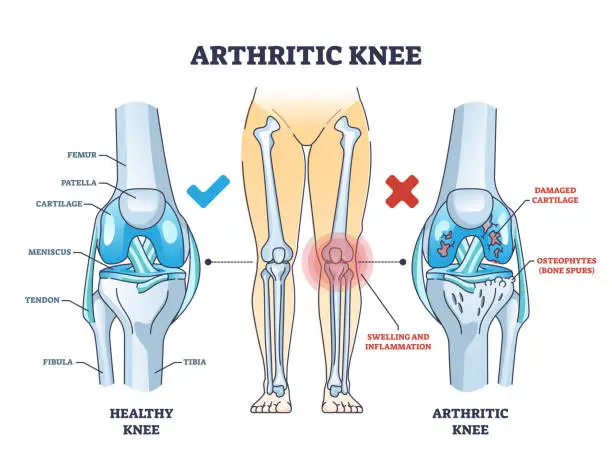 Vector illustration of Arthritic knee or osteoarthritis and healthy bones comparison outline diagram