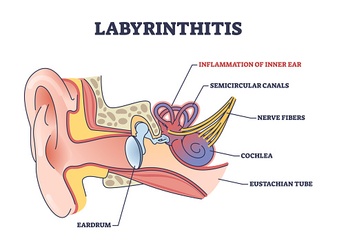 Labyrinthitis as inner ear infection and medical inflammation outline diagram. Labeled educational scheme with painful condition and medical cause for hearing and balance loss vector illustration.