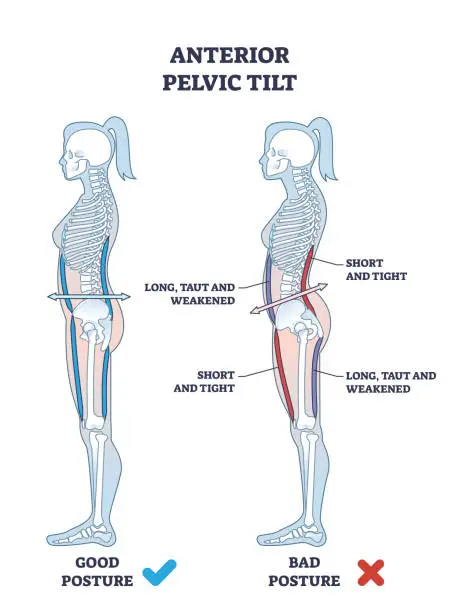 Vector illustration of Anterior pelvic tilt or APT as pelvis abnormal posture outline diagram