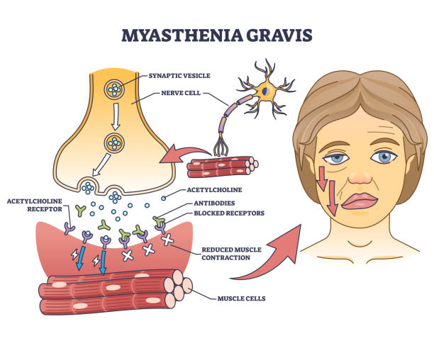 illustrazioni stock, clip art, cartoni animati e icone di tendenza di diagramma di contorno della miastenia gravis come malattia neuromuscolare autoimmune - acetylcholine