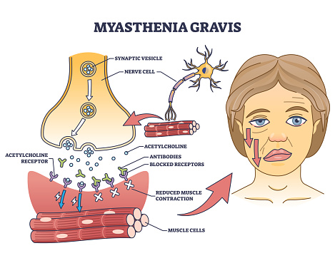 Myasthenia gravis as autoimmune, neuromuscular disease outline diagram. Labeled educational medical scheme with skeletal muscles weakness symptoms vector illustration. Anatomical illness explanation.