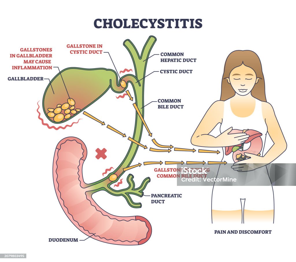 Gallbladder Visual Cholecystitis As Gallbladder Inflammation From Gallbladder Outline ...