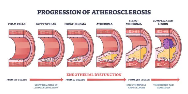 Vector illustration of Progression of atherosclerosis and thrombosis formation outline diagram
