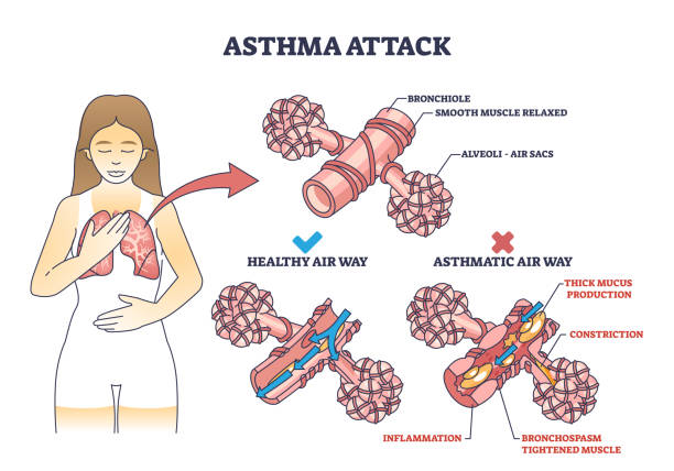 erklärung des asthmaanfalls im vergleich zum umrissdiagramm gesunder atemwege - inhaling human lung problems anatomy stock-grafiken, -clipart, -cartoons und -symbole