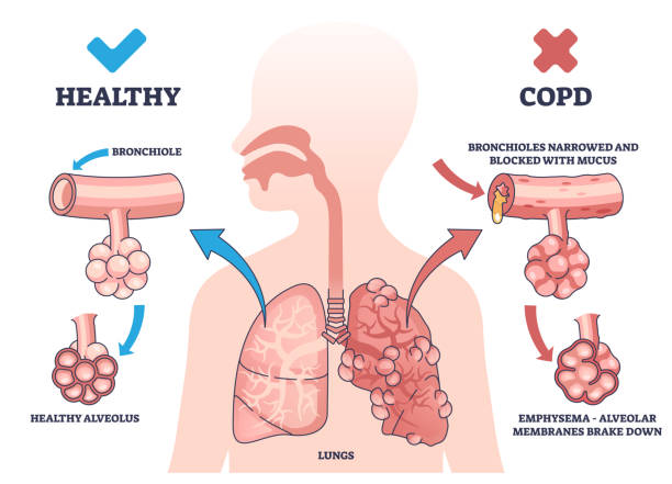 Anatomie-Poster COPD – Chronisch Obstruktive Lungenerkrankung Erklärt Mit Illustrationen & Infos