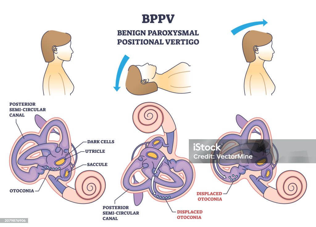 Bppv Or Benign Paroxysmal Positional Vertigo Syndrome Outline Diagram bppv-or-benign-paroxysmal-positional-vertigo-syndrome-outline-diagram