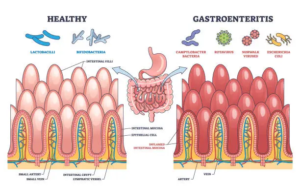 Vector illustration of Gastroenteritis or stomach flu microbiological explanation outline diagram