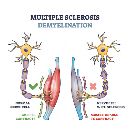 Multiple sclerosis demyelination compared with medical healthy nerves outline diagram. Labeled educational scheme with anatomical and medical autoimmune disease muscle contraction vector illustration