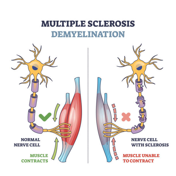 Multiple sclerosis demyelination compared with healthy nerves outline diagram Multiple sclerosis demyelination compared with medical healthy nerves outline diagram. Labeled educational scheme with anatomical and medical autoimmune disease muscle contraction vector illustration medulla stock illustrations