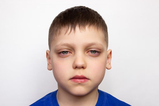 Close-up portrait of a child with red puffy eyes, isolated on a white background. Unhealthy appearance. Irritation and itching of the eyes caused by conjunctivitis, inflammation, infection. Allergy