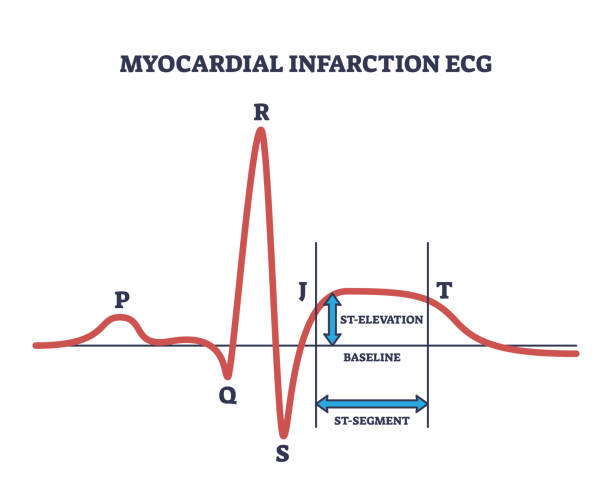 Irregular Ecg Examples Abnormal Ecg Labeled 160+ Abnormal Ekg Stock Photos, Pictures
