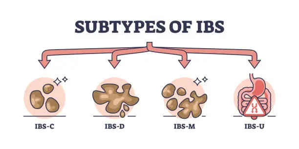 Vector illustration of Subtypes of IBS or irritable bower syndrome classification outline diagram