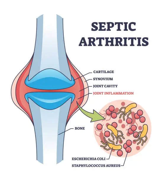 Vector illustration of Septic arthritis joint inflammation with medical explanation outline diagram