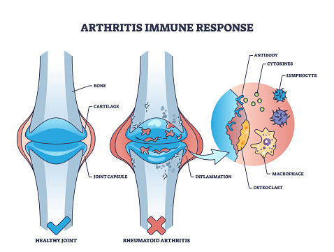 Arthritis immune response with rheumatoid bone disease outline diagram. Labeled educational medical condition with painful joints and inflammation vector illustration. Cartilage chronic problem.