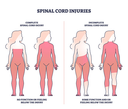 Spinal Cord Injuries With Complete Or Incomplete Trauma Outline Diagram ...