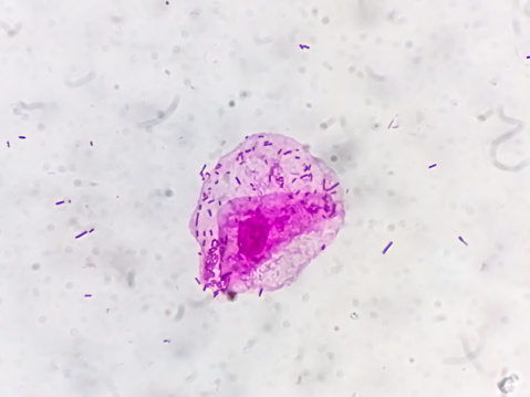 Microscopic close view of high vaginal swab Gram stain smear, 100x. diagnosis of Bacterial vaginosis (BV).