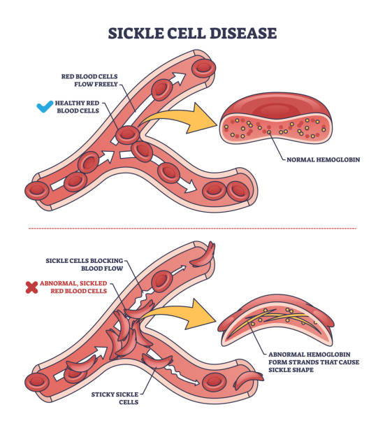 비정상적인 적혈구 모양을 가진 겸상 적혈구 질환 개요도 - blood cell anemia cell structure red blood cell stock illustrations