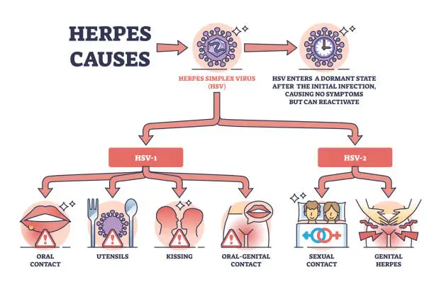 Vector illustration of Herpes causes and medical skin HSV virus transmission outline diagram.