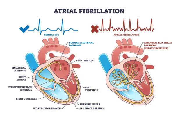 Vector illustration of Atrial fibrillation as abnormal heart beat frequency disease outline diagram