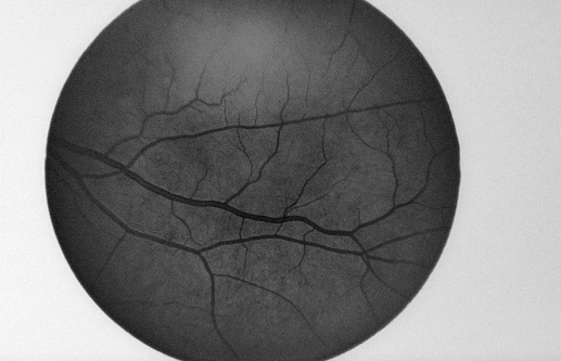 Retina of the eye -Síndrome de von Hippel-Lindau