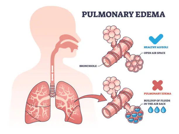 Vector illustration of Pulmonary edema condition with fluid buildup in air sacs outline diagram