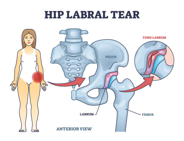 ilustraciones, imágenes clip art, dibujos animados e iconos de stock de explicación del desgarro del labrum de la cadera como diagrama de esquema de daño óseo del labrum médico - cadera
