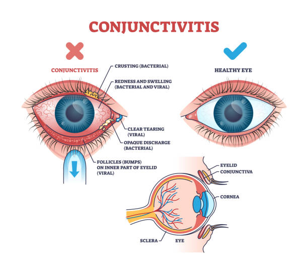 istock Conjunctivitis or pink eye medical condition explanation outline diagram 2082253070