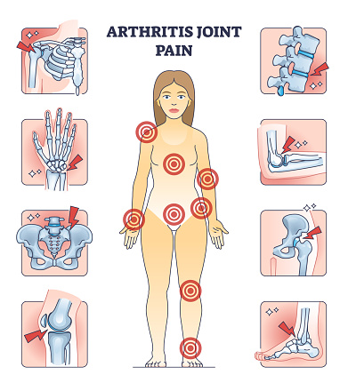 Arthritis joint pain with affected locations on human body outline diagram. Points of painful skeletal areas with anatomical chronic or acute illness vector illustration. Skeleton bone Inflammation.
