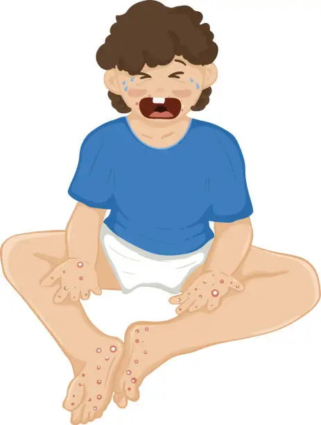 Vector illustration of hand foot and mouth disease