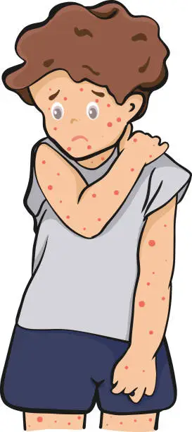 Vector illustration of chickenpox,disease ,red rash