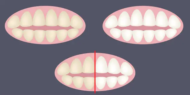 Vector illustration of Teeth whitening. Before and after