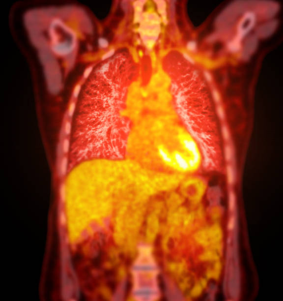 istock A PET-CT scan image is a diagnostic visualization combining Positron Emission Tomography (PET) and Computed Tomography (CT) for Helps in finding cancer recurrence. 2083816174