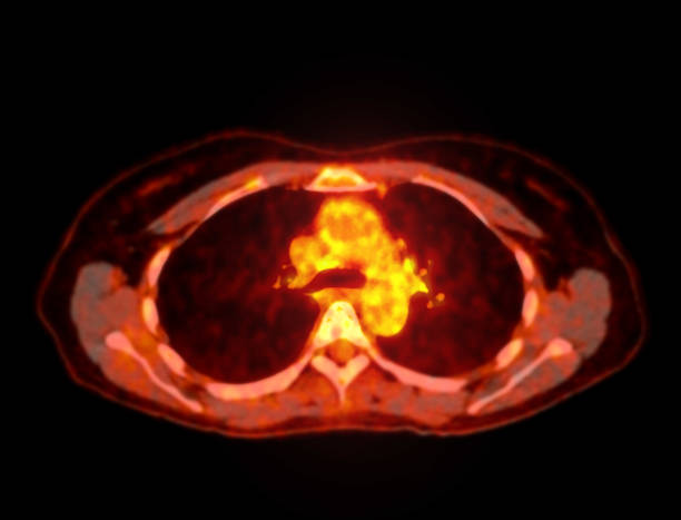 istock A PET-CT scan image is a diagnostic visualization combining Positron Emission Tomography (PET) and Computed Tomography (CT) for Helps in finding cancer recurrence. 2083816448