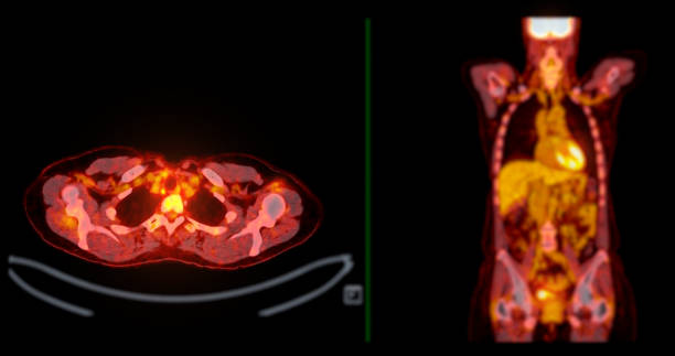 istock A PET-CT scan image is a diagnostic visualization combining Positron Emission Tomography (PET) and Computed Tomography (CT) for Helps in finding cancer recurrence. 2083816984