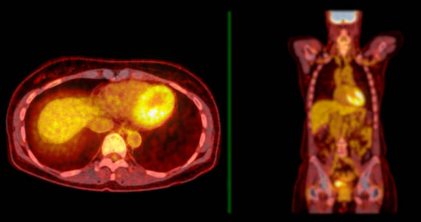 istock A PET-CT scan image is a diagnostic visualization combining Positron Emission Tomography (PET) and Computed Tomography (CT) for Helps in finding cancer recurrence. 2083817515