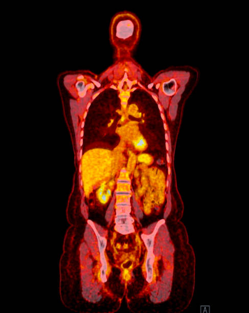 istock A PET-CT scan image is a diagnostic visualization combining Positron Emission Tomography (PET) and Computed Tomography (CT) for Helps in finding cancer recurrence. 2083820790