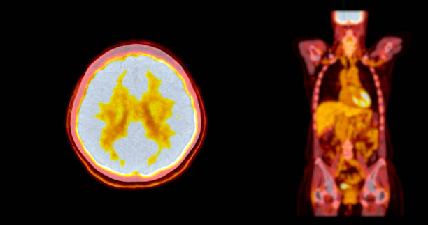 istock A PET-CT scan image is a diagnostic visualization combining Positron Emission Tomography (PET) and Computed Tomography (CT) for Helps in finding cancer recurrence. 2083820811